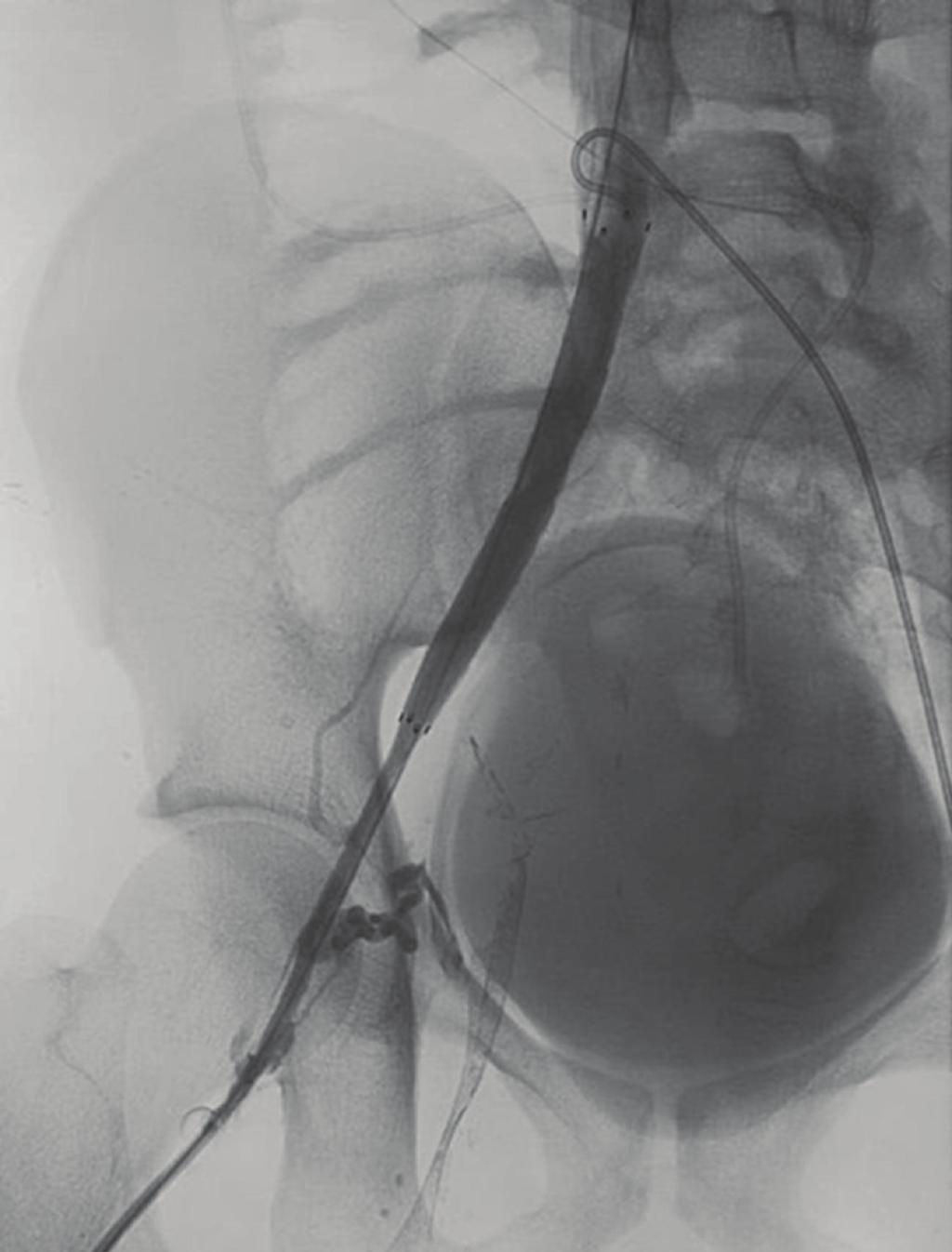 The right iliac lesions were progressively dilated as demonstrated in Figure 4. Figure 4(a) demonstrated the right iliac system during initial balloon angioplasty.