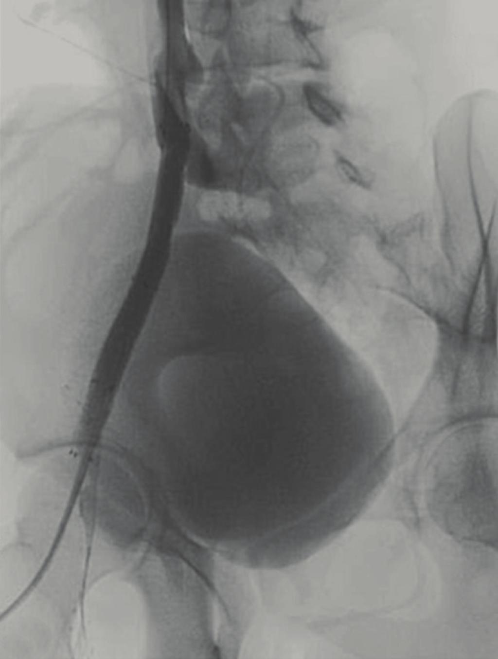 A diagnostic catheter was placed from the left common femoral to the IVC bifurcation and the location of the left common iliac vein was marked before stent placement.