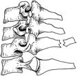 Compression fractures have an intact posterior vertebral body
