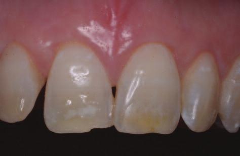 This is the immediate result and total eradication of the white spots may continue after initial treatment Figure 3: Appearance three months after application of the resin.