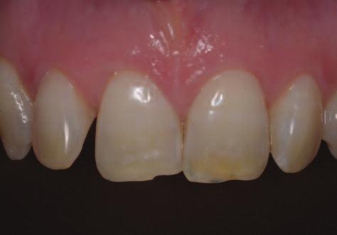 The Icon resin infiltrant was applied only once to the surface of the tooth sandblasting helps to open up the enamel tubules so that better penetration of the hydrochloric acid can be achieved.