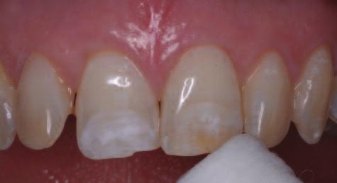 Figure 5: The result after rinsing. The etched appearance on the teeth shows where the gel was placed.