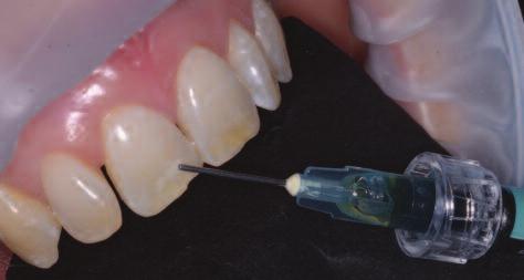 The direct application of the resin onto the tooth using a special applicator.