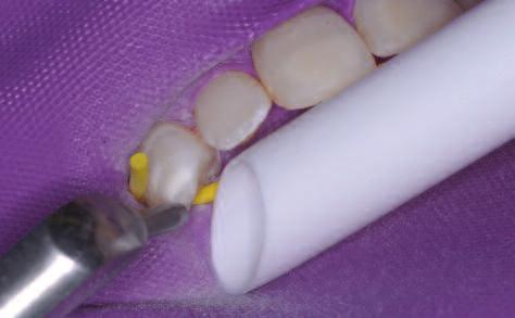 Figure 9: If the white mark is more extensive, the lesion can be sandblasted first to allow for deeper penetration of the resin.