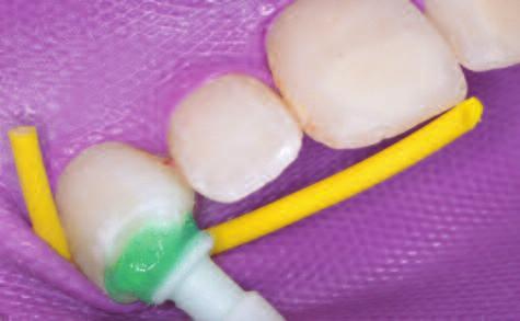 A sponge cup applicator is used to apply the hydrochloric acid. 10. The tooth is light cured for 30 seconds 11. Observation of the result can be undertaken and reviewed 12. Photos taken.