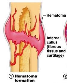 Inflammatory Phase The injury leads to: Soft tissue injury Disruption of blood vessels Bony injury/fracture and separation of fragments Haematoma formation assisted by inflammation and dilatation of