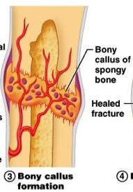 Hard callus is then formed by bone cuffs being formed at the periphery of the fracture and working towards