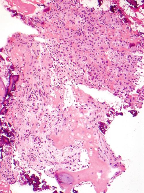 Bone/Osteoid Producing Lesions 15 Figure 2.9 Although not very cellular, one can appreciate a somewhat monotonous cell population in this osteoblastoma.