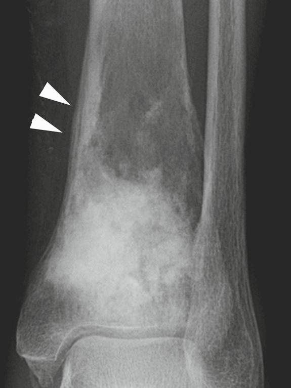 Bone/Osteoid Producing Lesions 17 Figure 2.11 An osteosarcoma of the lower tibia that is predominantly osteoblastic and also shows lucent areas.