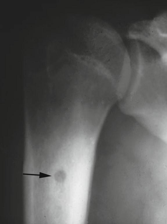 12 Frozen Section Library: Bone Figure 2.7 An osteoid osteoma of the humerus showing the characteristic lucent nidus (arrow) surrounded by sclerotic bone. Figure 2.8 An osteoblastoma appearing on plain radiograph (a) as an expansile lesion in the transverse process of the third lumbar vertebra (arrows).