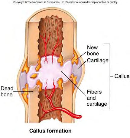Fracture Repair Nearby blood vessels and cells invade clot Bring fibroblasts,