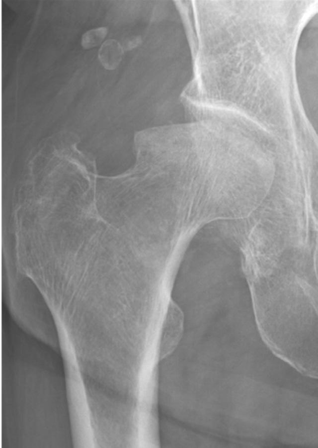 C A B D E Fig. 2. A 77-year-old woman with a subchondral insufficiency fracture of the right femoral head.