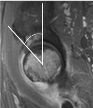 (B) Lateral radiograph of the lumbar spine shows decreased lumbar lordosis (24.7 ).