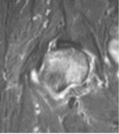 (D) On the mid-sagittal T2-weighted MRI, anterior centeredge angle was decreased to 29.2. (E) Radiograph at 2 months follow-up shows rapidly progressive collapse of the femoral head. Table 1.