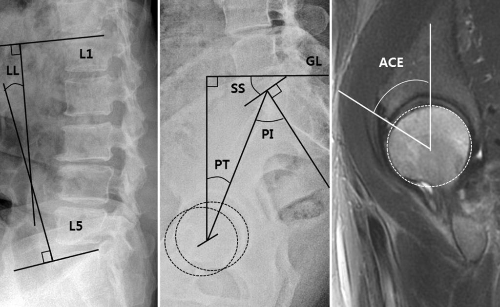 A B C Fig. 3. Images of the lumbar spine, pelvis, and the hip.