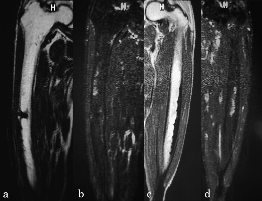a and c represent T1 weighted imaging while b and d are T2 weighted imaging.
