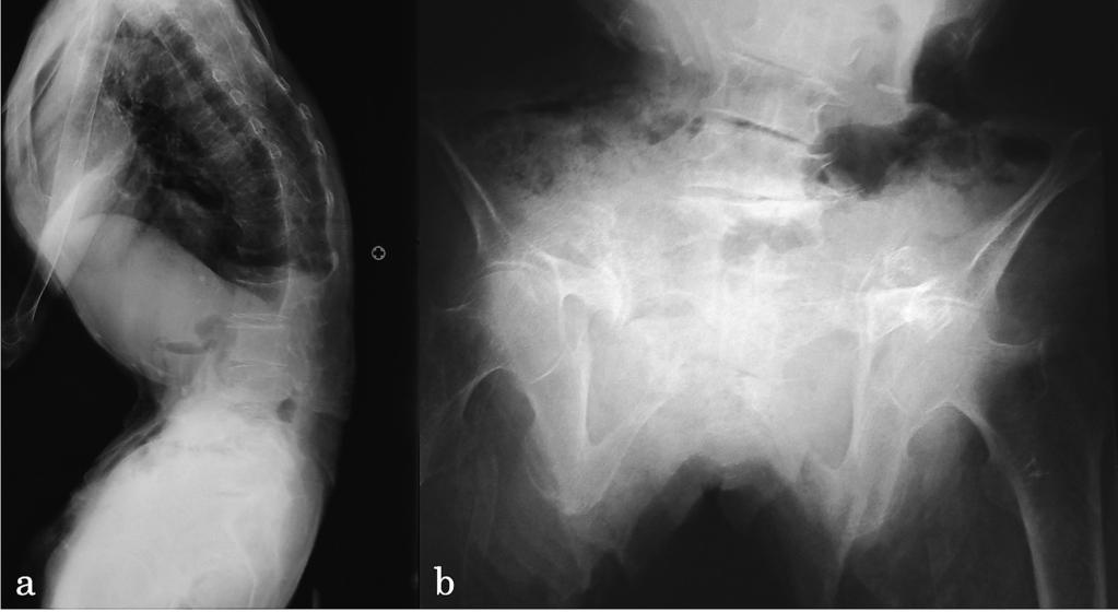 2015 61 Lateral radiography of the vertebra (a) and antero posterior