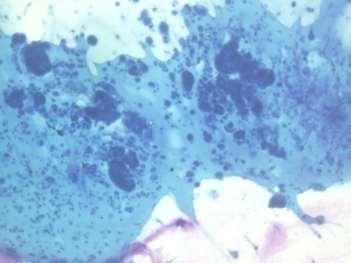 of pleural effusion (Giemsa, x400) Fig-2: Photomicrograph of metastatic adenocarcinoma in pleural effusion showing acini of pleomorphic tumor