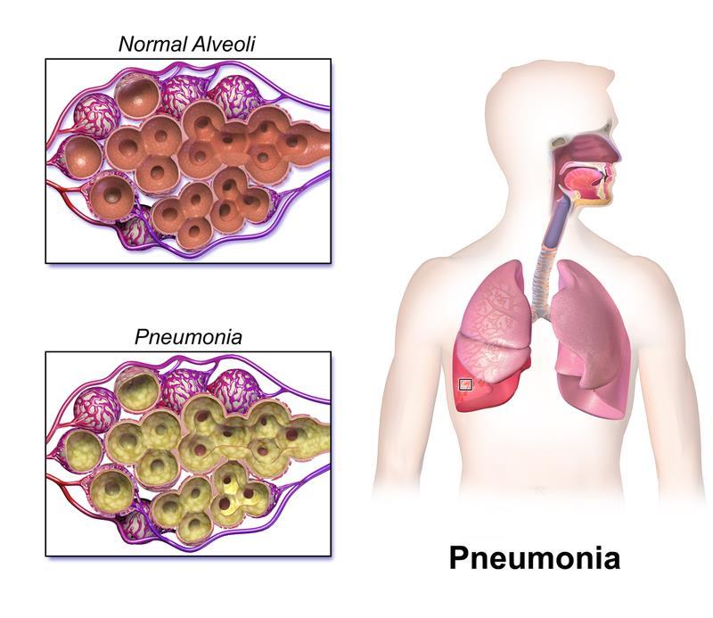 Figure 02: Pneumonia Clinical Features Acute onset of fever Dyspnea Productive cough Chest pain Pleural friction rub Effusion What is the
