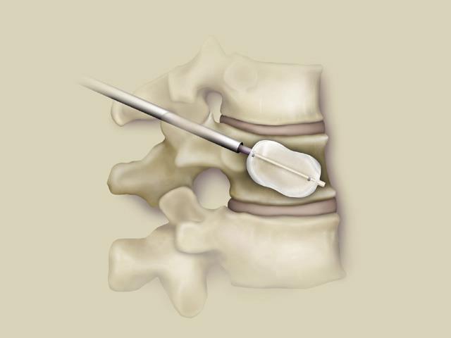 Surgery Vertebroplasty: Injection of bone cement to support weakened