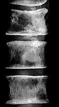 Osteolytic and osteoblastic metastases