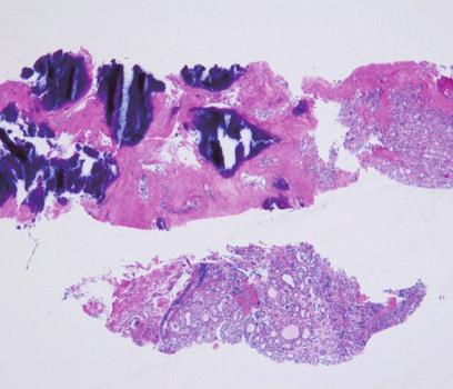40). (C) A high-power view shows the typical histologic features of papillary