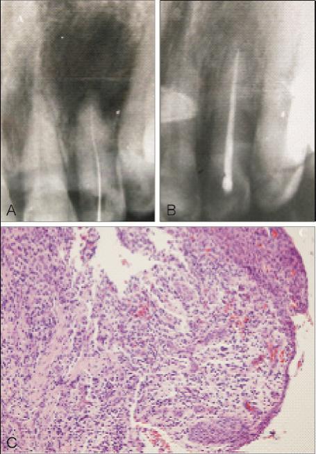 Wen-wei Xia et al. 155 Case 4 A 50-year-old female patient experiencing discomfort in the 36 area was referred to our department.