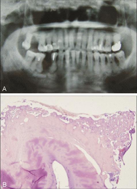 5 cm lesion images at the apical area of the left side molar and a small isolated bone was observed in the center of the lesion.