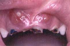 Oral Health Screening Intraoral - Infection/Swelling