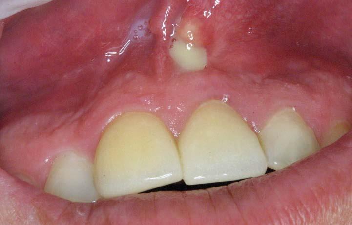 swelling on the gums, obvious signs of drainage