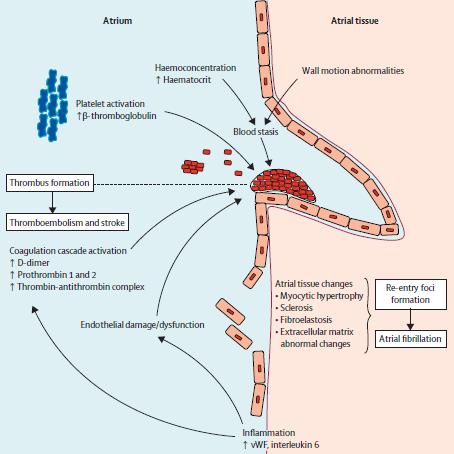 Von Willebrand factor (vwf) is a well-established index of endothelial damage and dysfunction vwf has consistently been shown to be raised in patients with AF High levels of vwf are prognostically