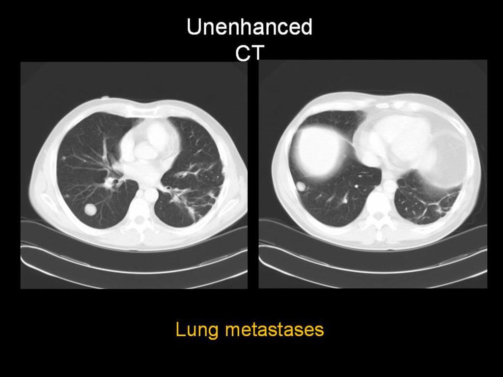 Fig. 9: Lung Metastastes on