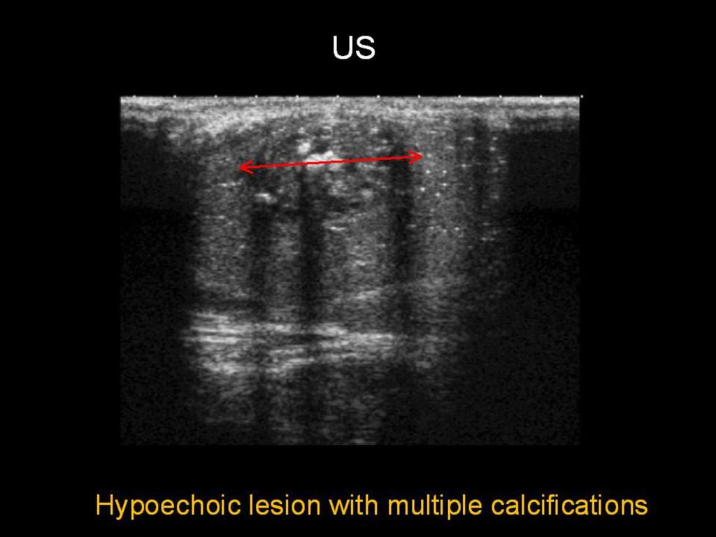 Fig. 12: Fibrous scar: Hypoechoic
