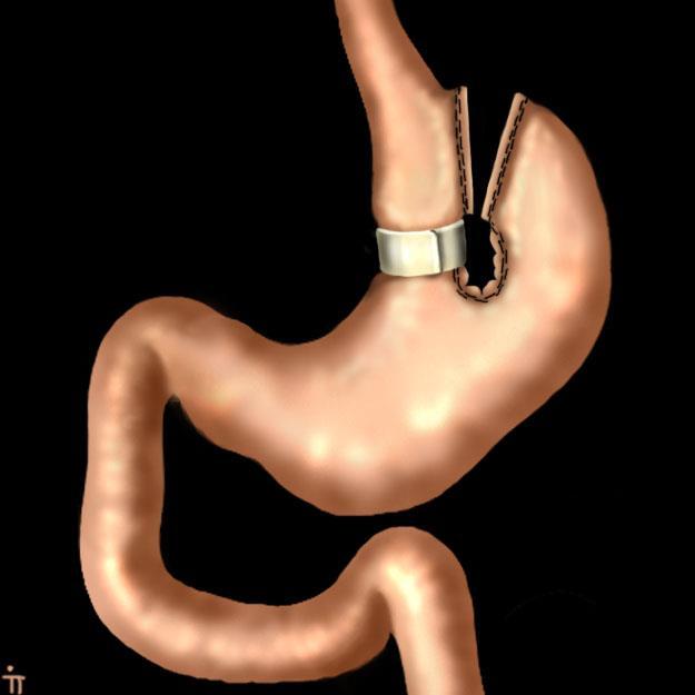 gastroplasty