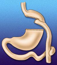 Gastric Bypass how it works? Apetite loss?