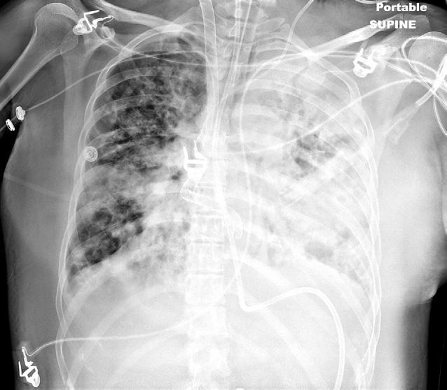 Both displacements were confirmed with the use of chest and abdominal roentgenograms performed in the intensive care unit (Figs 3, 4).