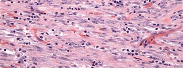 occasionally recur with higher-grade histology: Increased cellularity or nuclear atypia, high mitotic rate