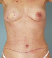 Reconstruction Specific TRAM Hardened areas of breast