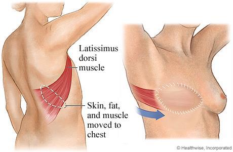 Reconstruction Specific Latissimus Flap Flap portion through
