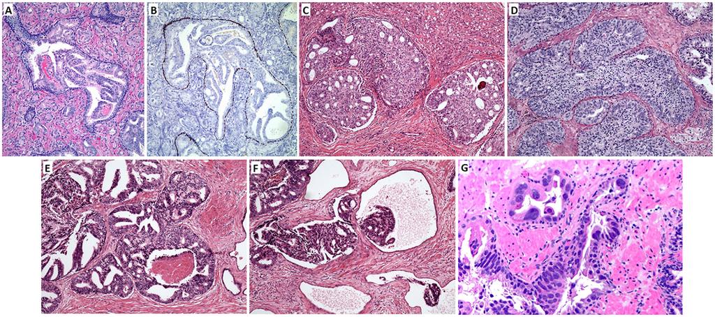 EUROPEAN UROLOGY ONCOLOGY 1 (2018) 21 28 23 Table 1 Intraductal carcinoma of the prostate (IDC-P): common histological deatures.