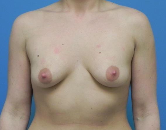 Drains in Breast Augmentation No evidence to support