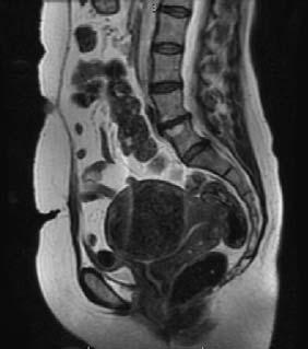 MRI image CT Large fibroid on this MR