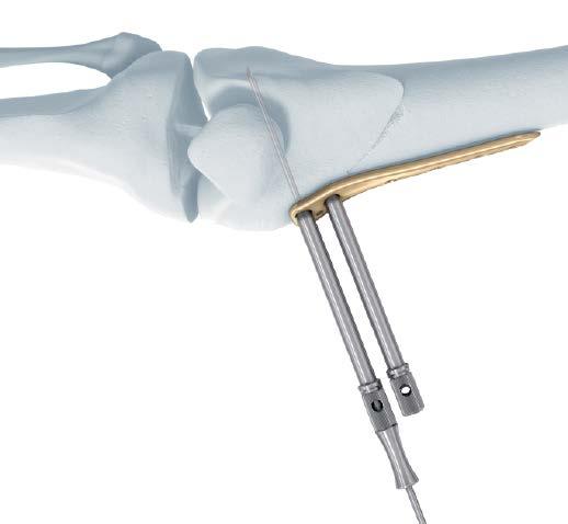 the implant shaft is parallel to the femoral shaft. Insert the 2.0 mm TOMOFIX Guide Sleeve into the most distal and anterior 4.3 mm threaded drill guide.