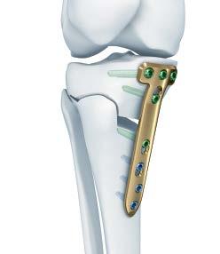 TOMOFIX MEDIAL DISTAL FEMUR PLATE FOR CLOSED-WEDGE VARUS FEMORAL OSTEOTOMIES The DePuy Synthes Trauma TOMOFIX
