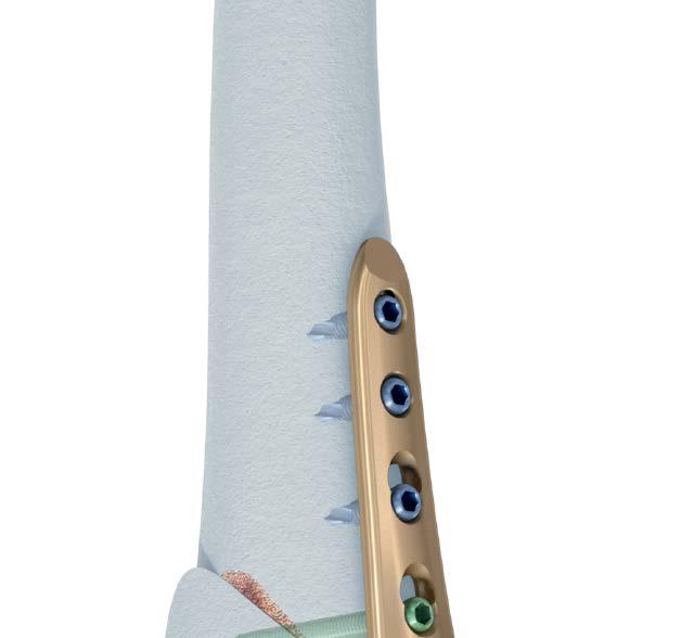 INDICATIONS As part of the DePuy Synthes Trauma TOMOFIX Osteotomy System, the TOMOFIX Medial Distal Femur Plate is