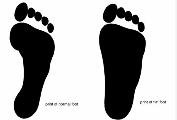 Flat foot Is a condition in which the medial longitudinal arch is depressed or collapsed.