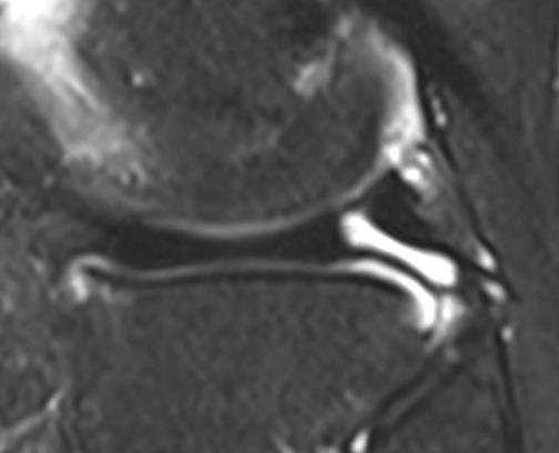 Meniscal Attachments: lateral Lateral attachments capsule popliteus