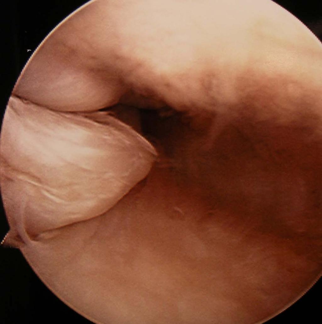 Displaced Meniscal Tears: importance Bucket handle tear Flipped ant/post horn detected early -