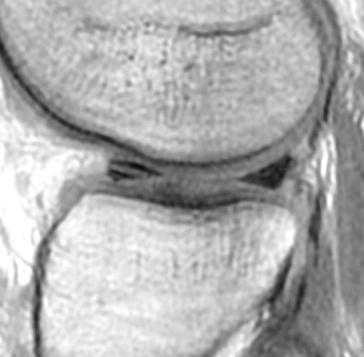 Meniscal Tear: Pitfalls Artifacts Patient motion Phase