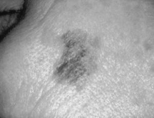 melanomafoundation.com  Nodular melanoma 15% Most aggressive Image source: www.aafp.